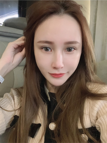 【小葉】自體脂肪膠-雙邊下臉凹+左上眼凹+夫妻宮+淚溝+黑眼圈-揮別苦情臉，找回年輕澎潤感！