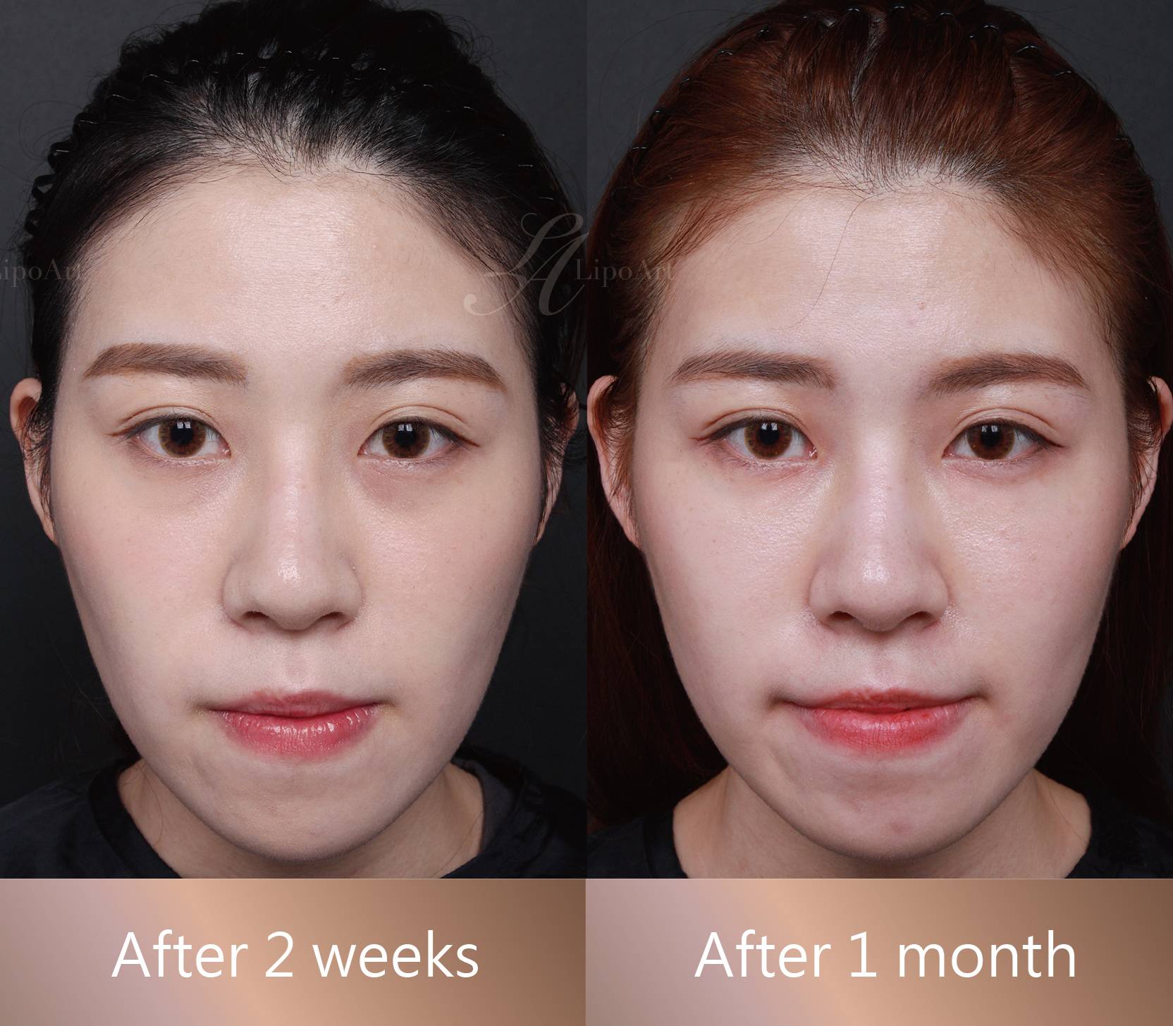 【素人女孩】卡麥拉隆鼻-小巧廷鼻超吸睛，正看側看都立體有型