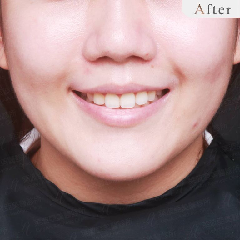 After