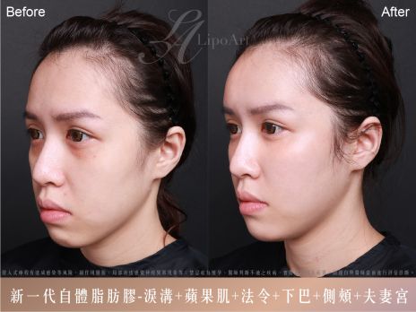 萊波亞 